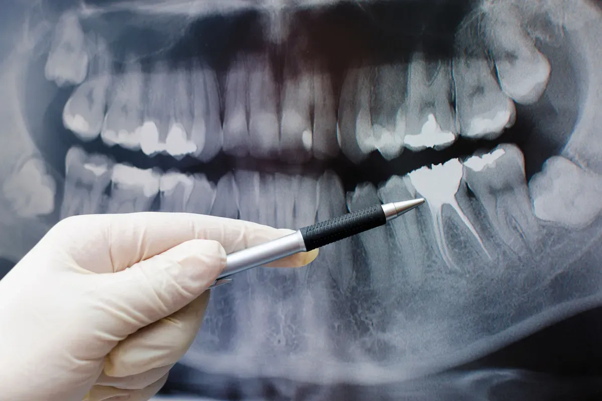 Analiza Ortopana Olovkom