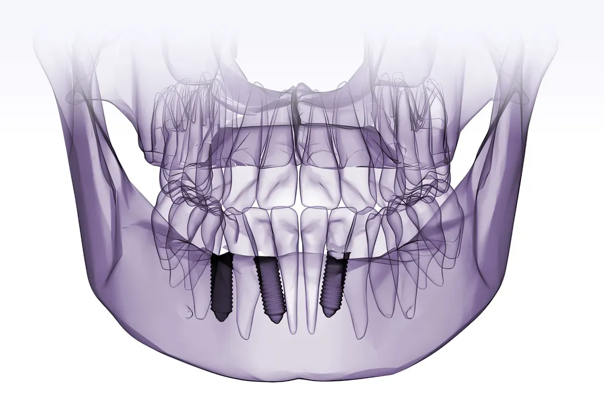 Imed 3D Snimka Celjusti Implantati