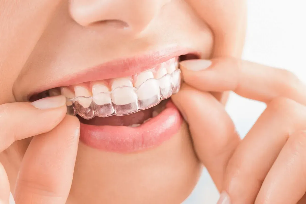 Invisalign Aparatic