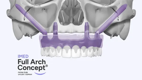 Imed Blog Full Arch Treatment 1